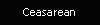 Ceasarean